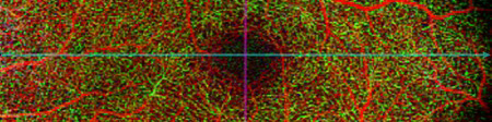 AngioPlex retina depth encoded